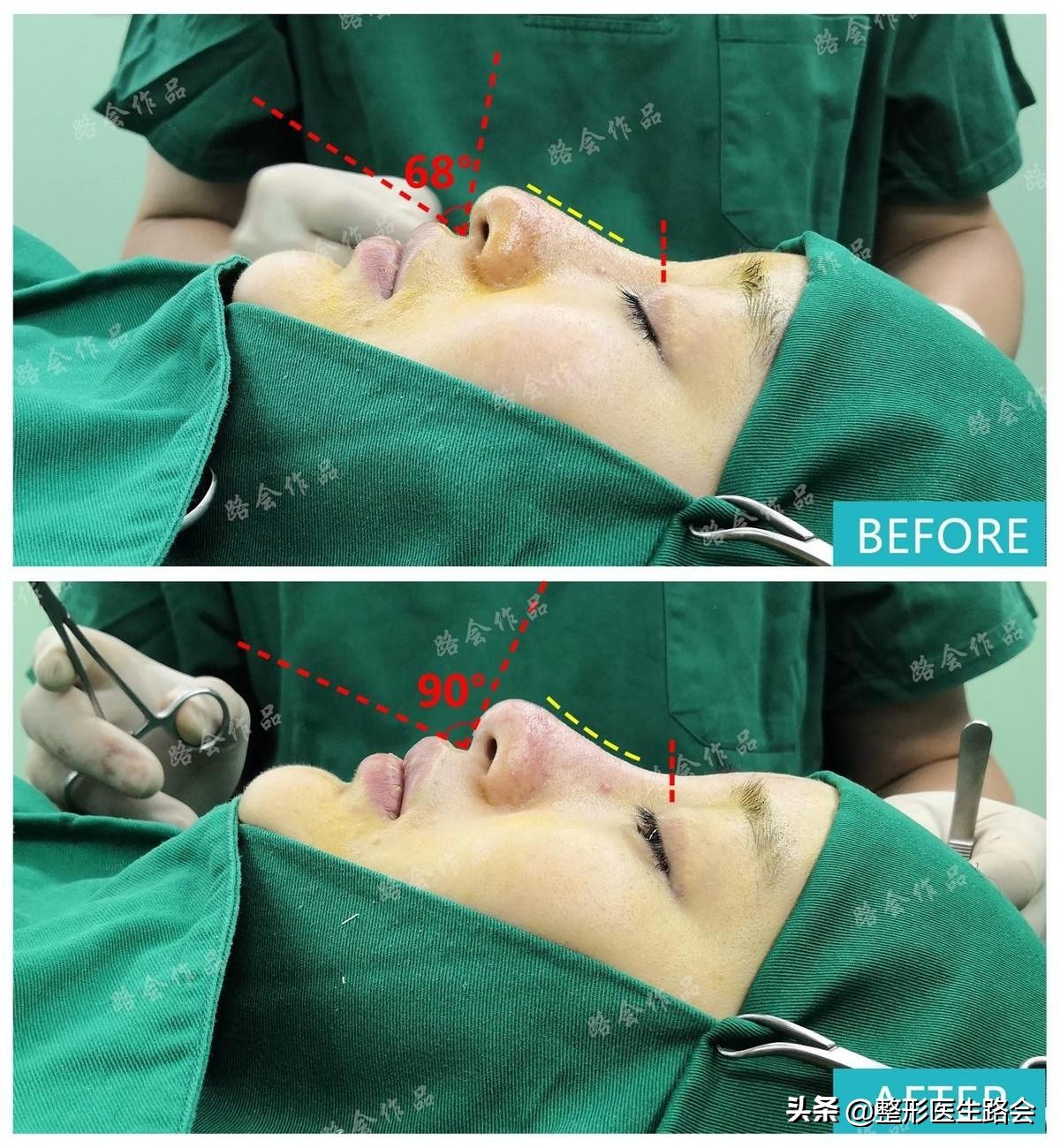 隆鼻手术全过程女生,隆鼻手术到底是怎么进行的