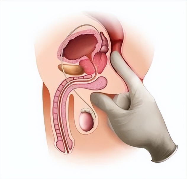 高位肛周脓肿自愈日记20篇,肛周脓肿破了自愈日记20篇