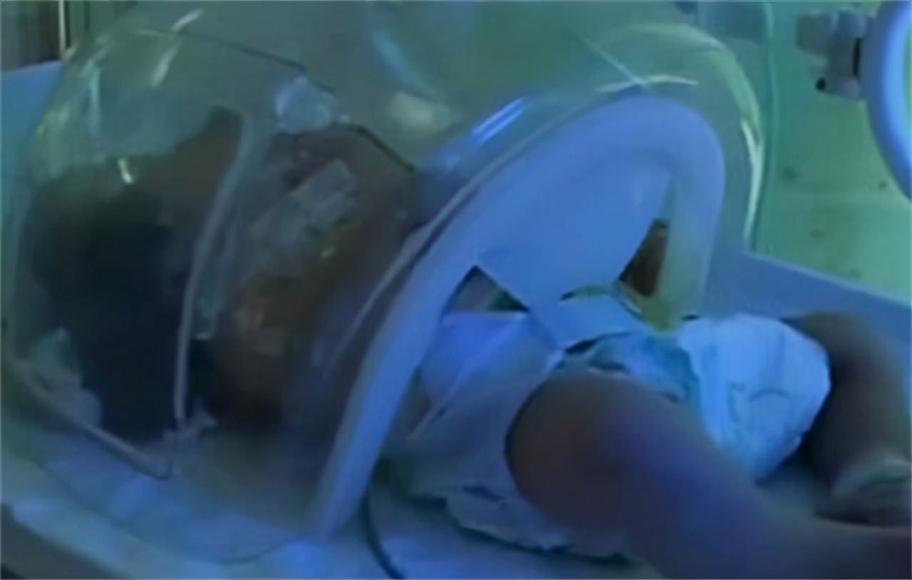 中国首例双头婴儿现状如何,全国首例双头婴儿现在咋样了