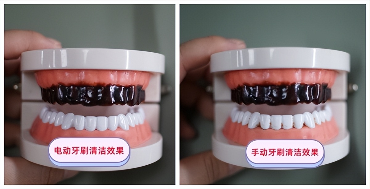 电动牙刷刷牙还是手动刷牙比较好,小孩子用电动牙刷还是手动牙刷