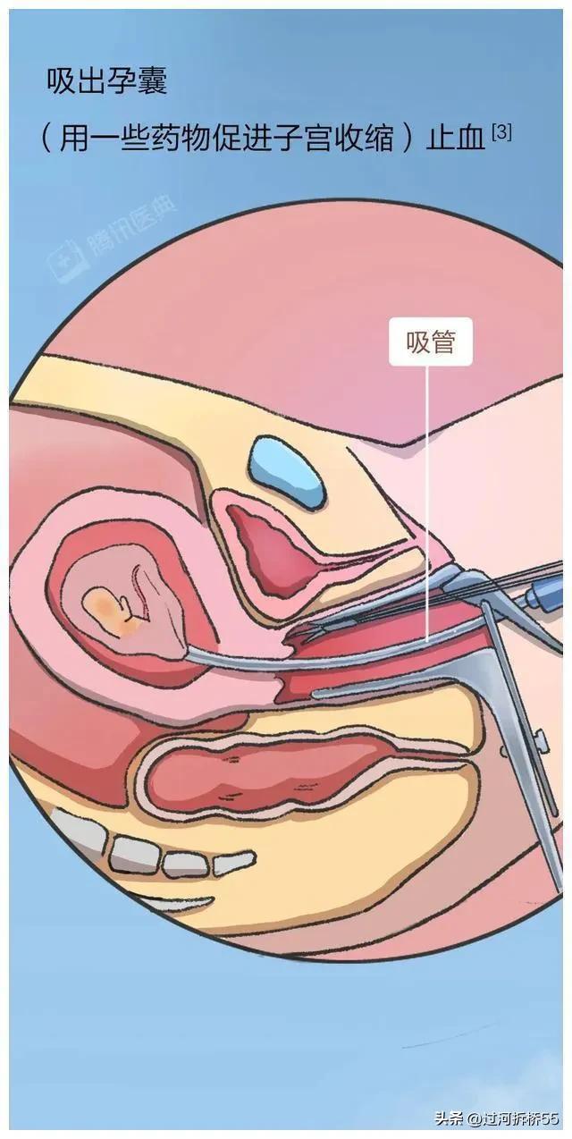 人流后的女生心里为什么会委屈,人流后女生身体会很虚弱