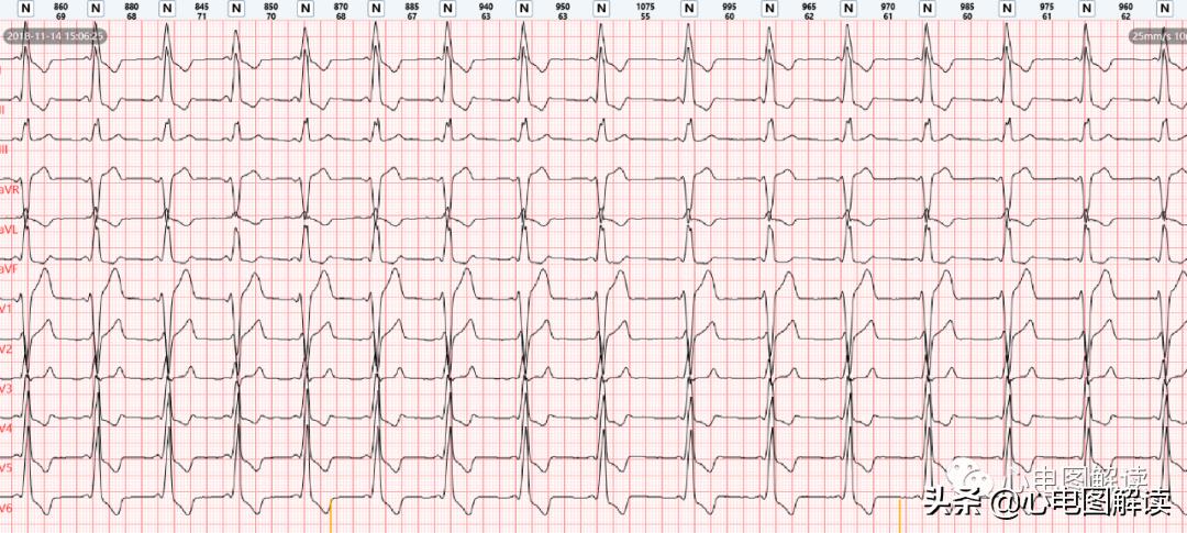 房性早搏与预激综合征,房性早搏伴阵性心动过速