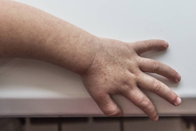 女生起红点,女生长红点怎么回事