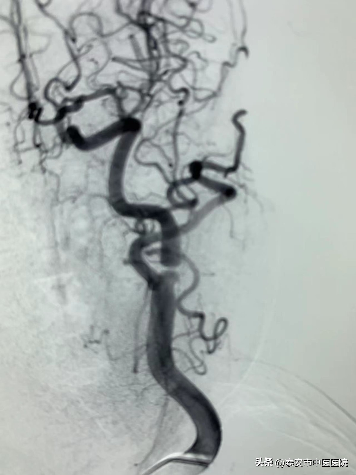 *安泰**市中医医院脑病外科成功开展一例高难度“颈动脉内膜剥脱术”
