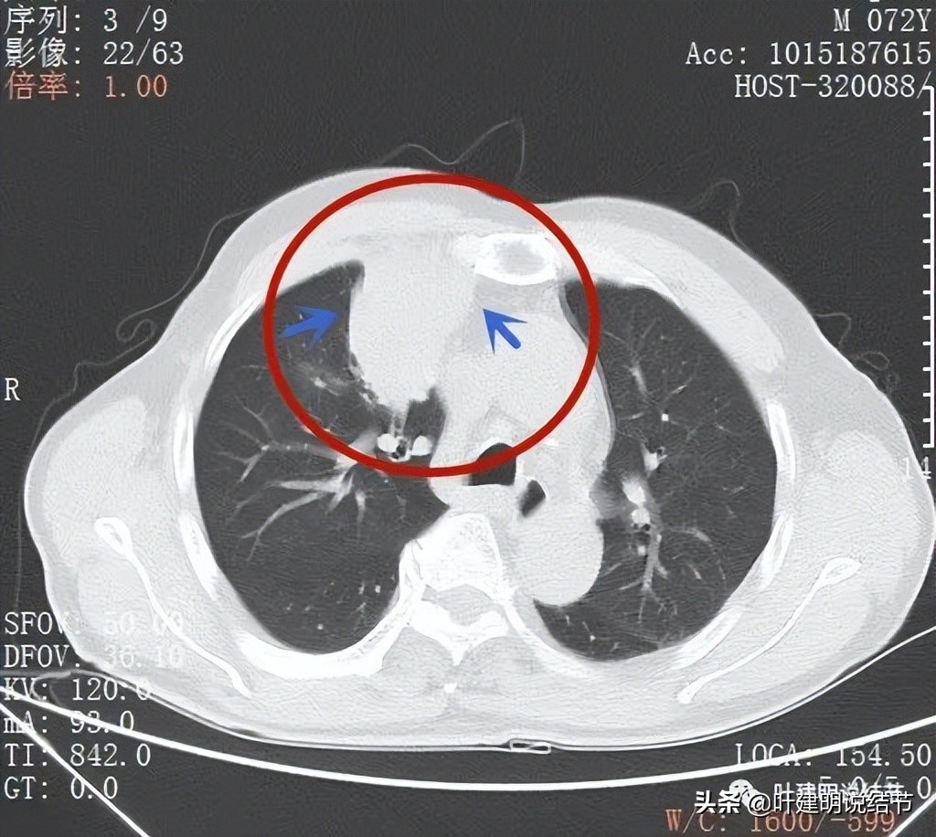 经验：肺占位超6厘米，不是癌还会是什么？临床上仍得多个心眼