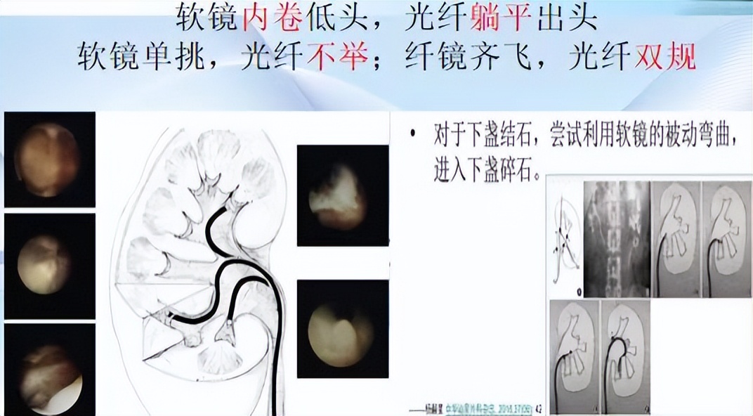 明知山有虎,偏向虎山行——肾斗士VS肾结石