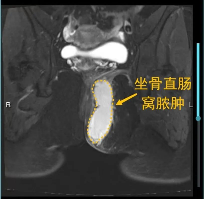 痔疮跟肛周脓肿的区别中医怎么讲,肛周肿痛误为痔疮