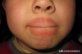 冬天孩子经常舔嘴唇涂抹清凉油,天气干燥小孩舔嘴巴