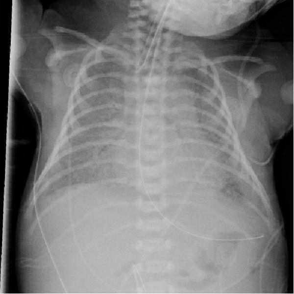 刚出生的小孩呼吸困难是怎么回事,小孩刚刚出生呼吸急促