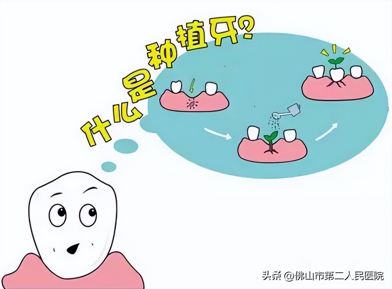 种植牙降价文章,种植牙的内幕你了解多少