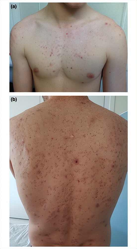 疮痍的原因和治疗方法,躯干部位痤疮
