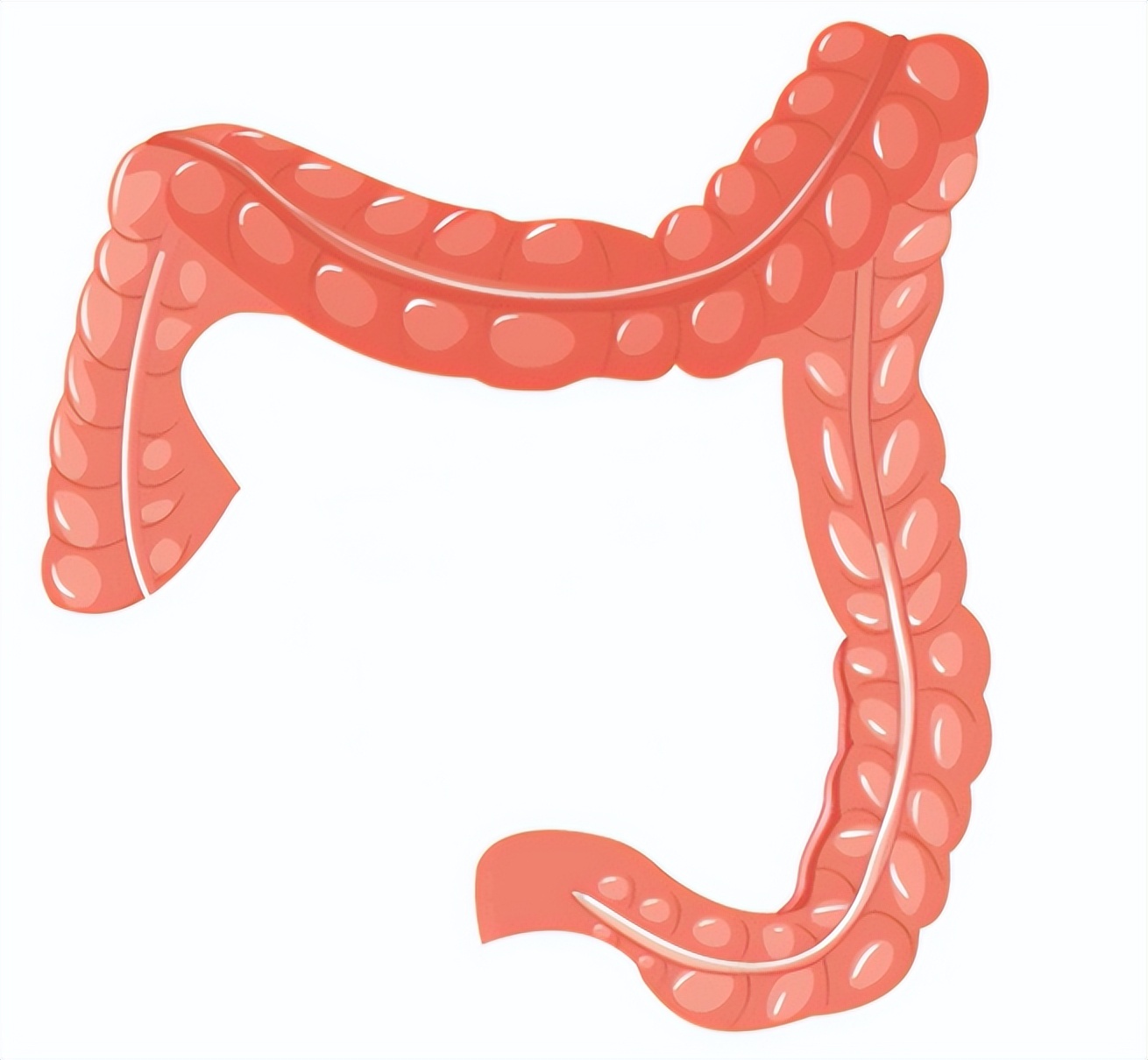 肠息肉癌变怎么提示,肠息肉出现征兆是不是已经癌变了