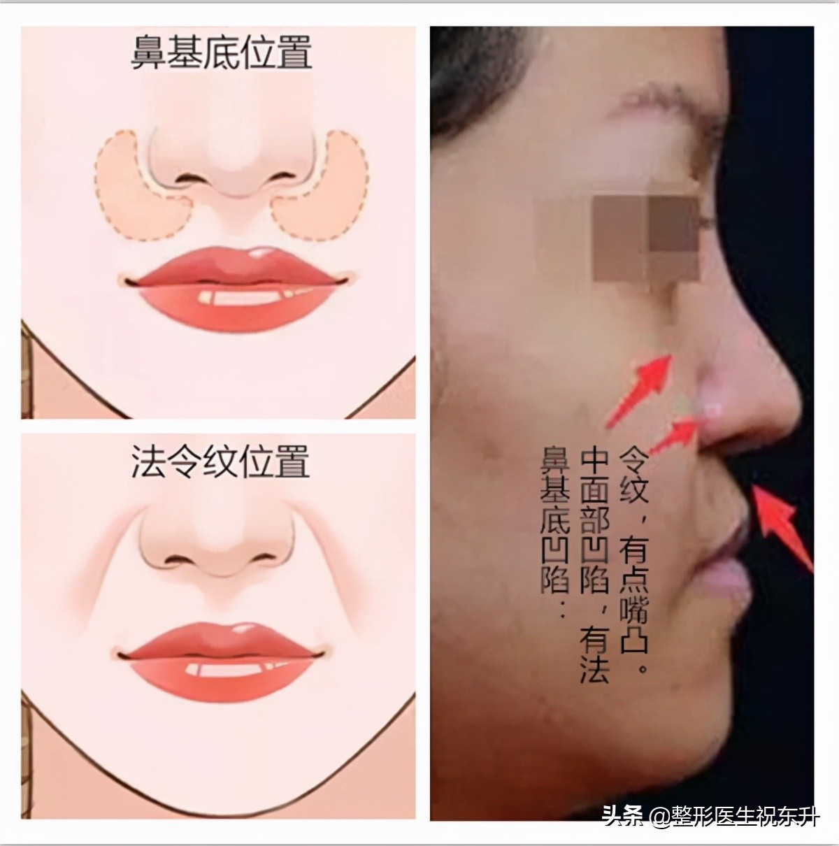 法令纹太深了怎么办？十有八九是这4种原因所致