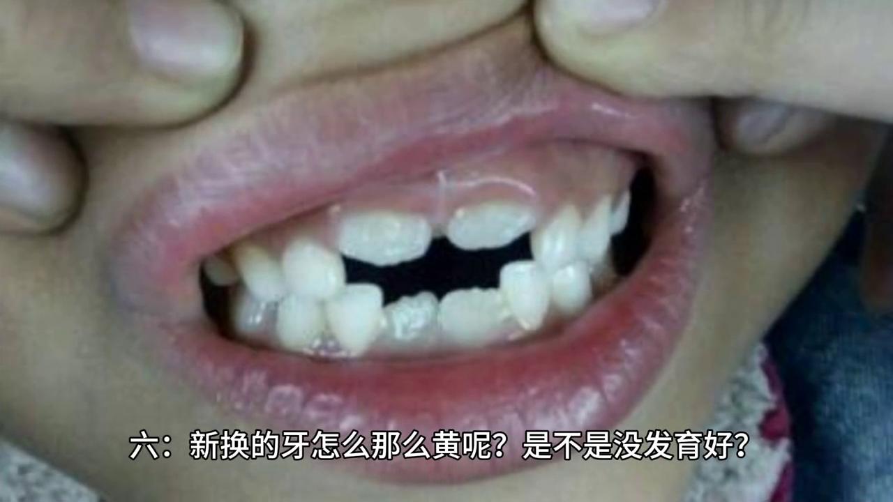 小孩换牙时长出双层牙怎么办,小孩换牙妈妈怎么引导