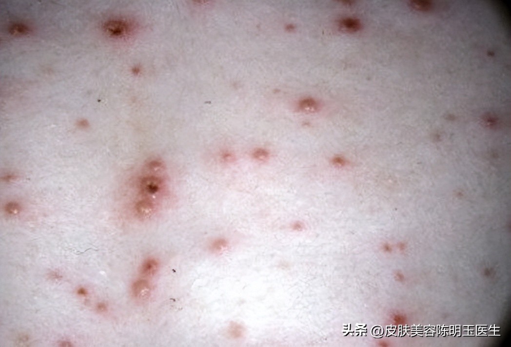 怎么最快的方法治愈水痘,如何判断水痘是轻症还是重症