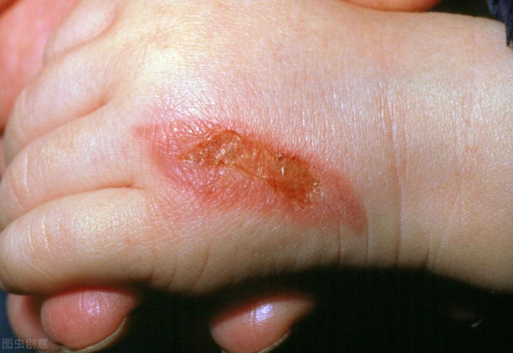 儿童烫伤应急处理方法,儿童热水烫伤用什么方法最快好