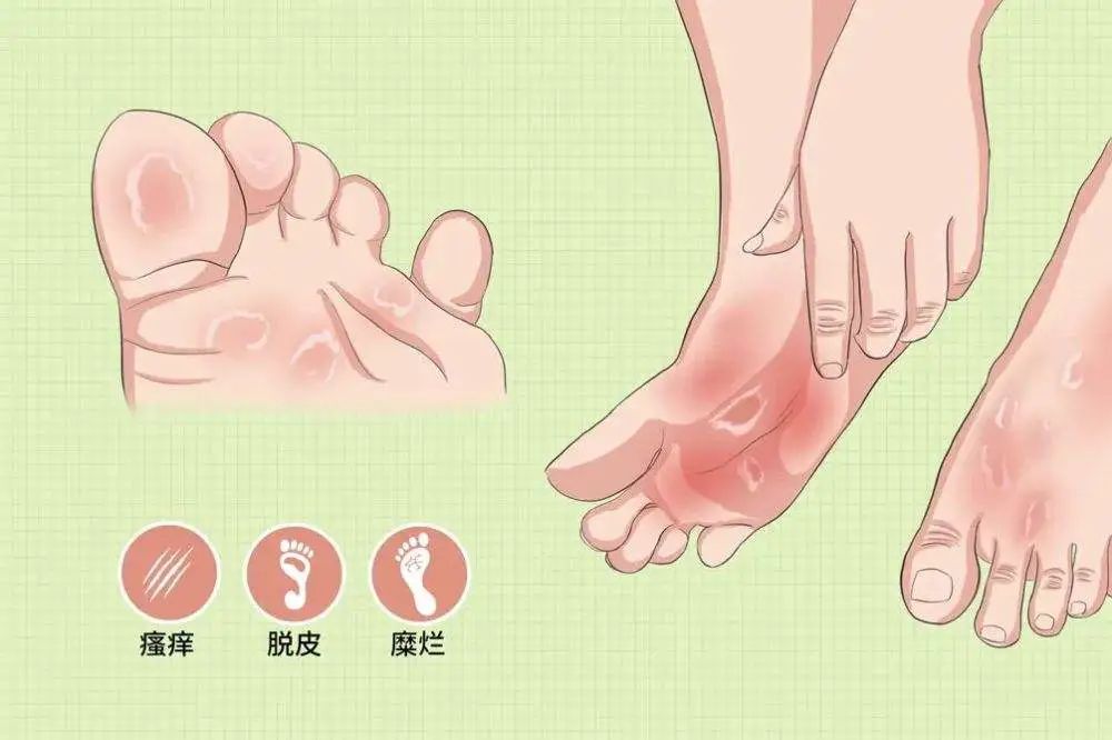 维生素b1治疗的脚气病是啥病,鸡鸣散治疗脚气病医案