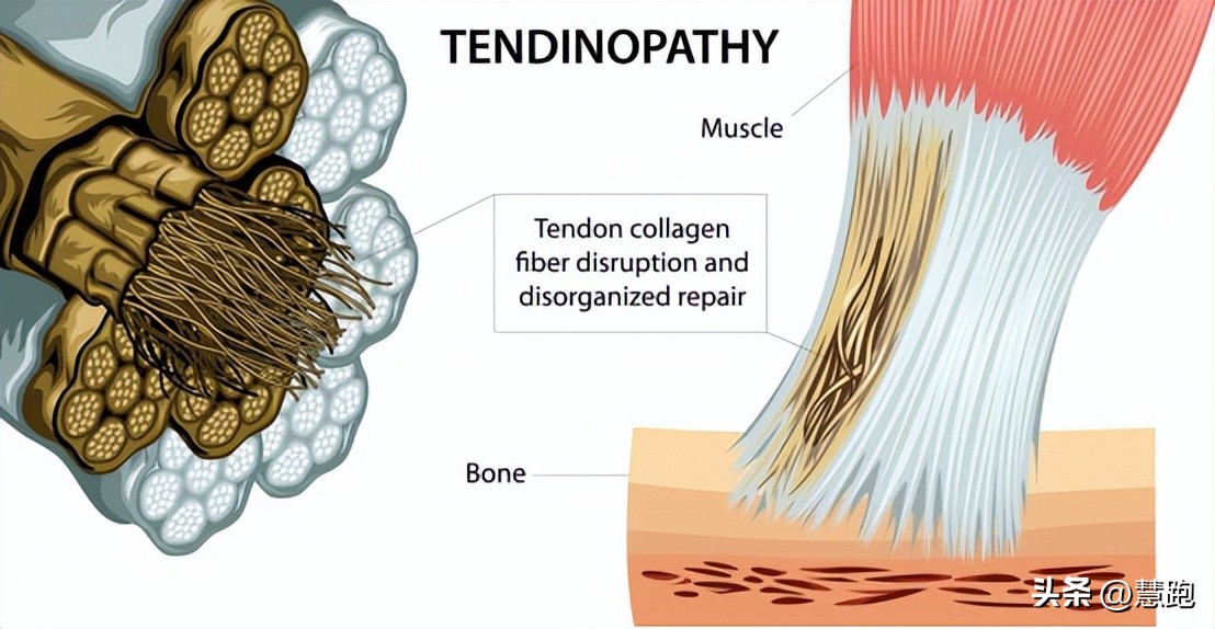 这类顽固性的跑步伤痛最让跑者头疼：4种有效康复方法教你破解