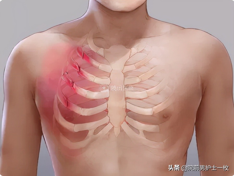 多发肋骨骨折的处置措施