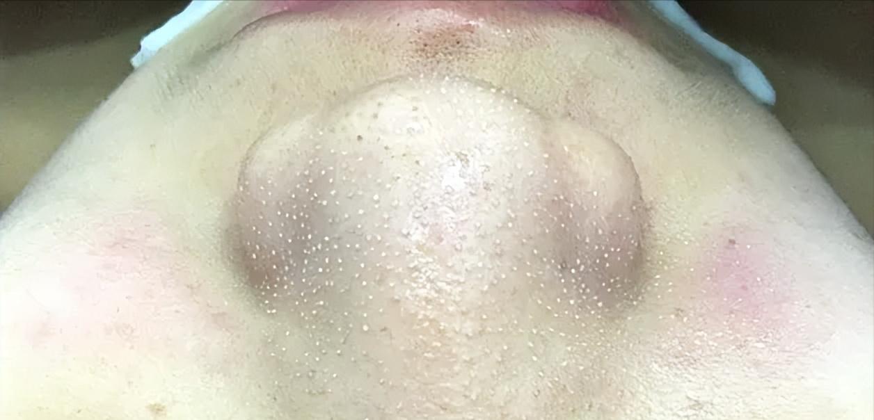 鼻子黑头感觉脏脏的,草莓黑头怎么去除最有效