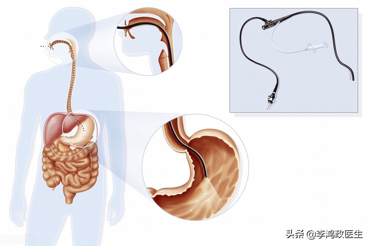常见癌症的体检筛查方法,体检癌症筛查需要多少费用