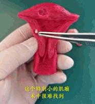 不同的子宫肌瘤都长啥样？看医生如何切除