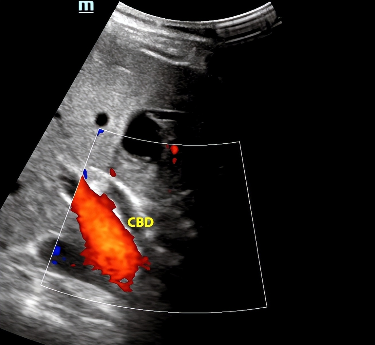 超声介入入门,手把手教你入门超声