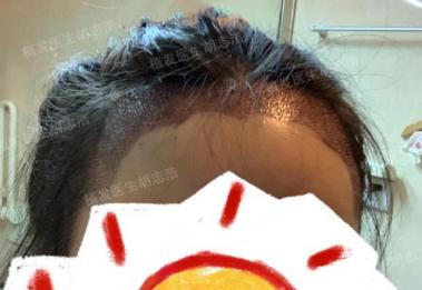 植发后后枕部的头发多久能恢复,植发手术后3个月恢复过程