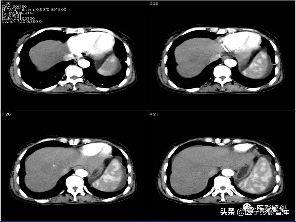肝炎性假瘤鉴别诊断,肝炎性假瘤影像学表现