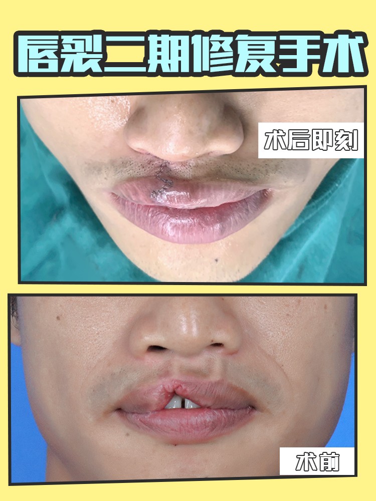 唇裂造成畸形牙矫正视频,唇裂缺陷怎么调理