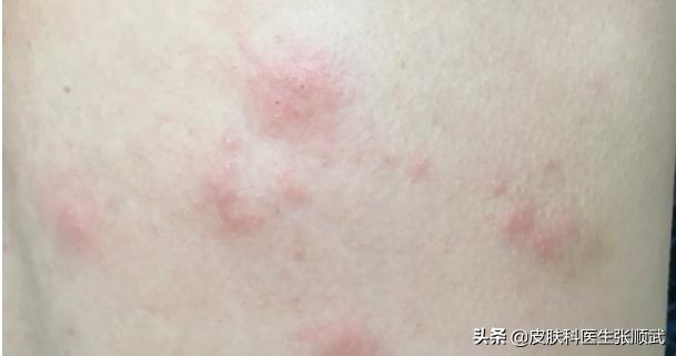 带状疱疹长腰上全部变成水泡了,腰疼出红疙瘩是带状疱疹吗
