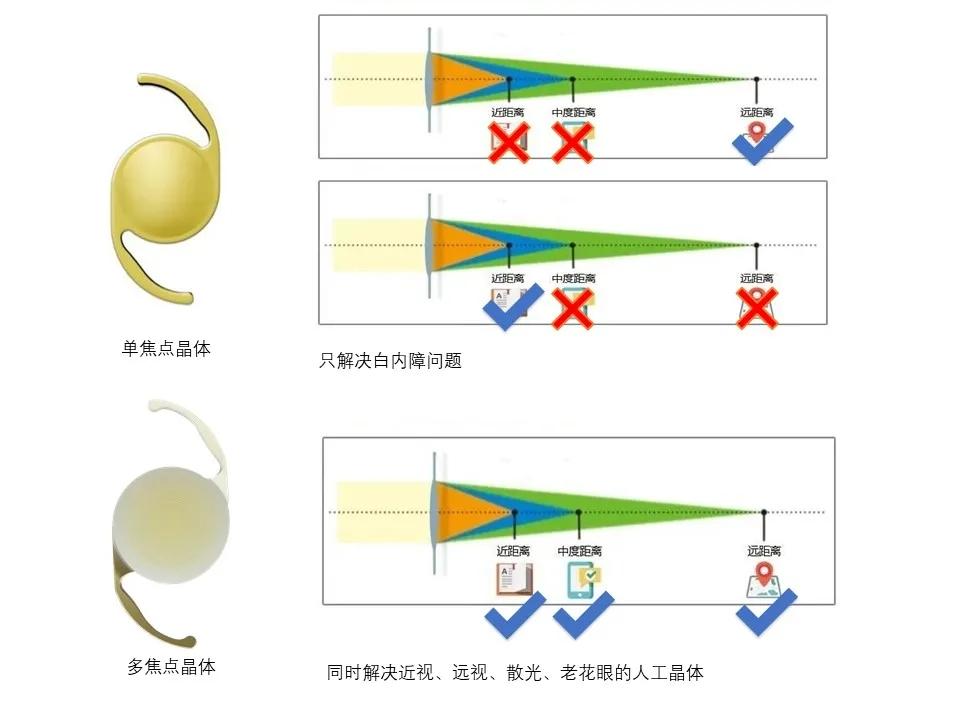 白内障最新晶体技术,白内障手术的晶体能矫正近视吗