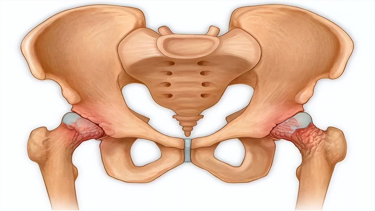 胯骨疼与哪些疾病有关,胯骨疼痛要警惕什么病