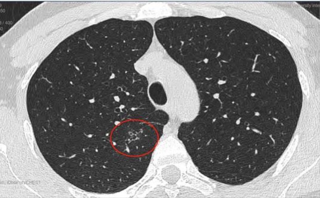 磨玻璃结节9*8mm建议随访,8mm磨玻璃结节一年没长