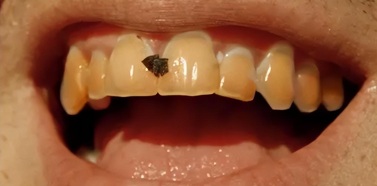 牙缝有牙垢怎么去除,牙缝牙垢又臭又硬怎么去除