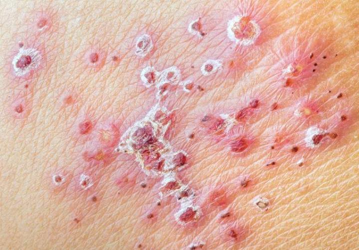 缠腰龙病如何发生的,缠腰龙是怎么样引起的