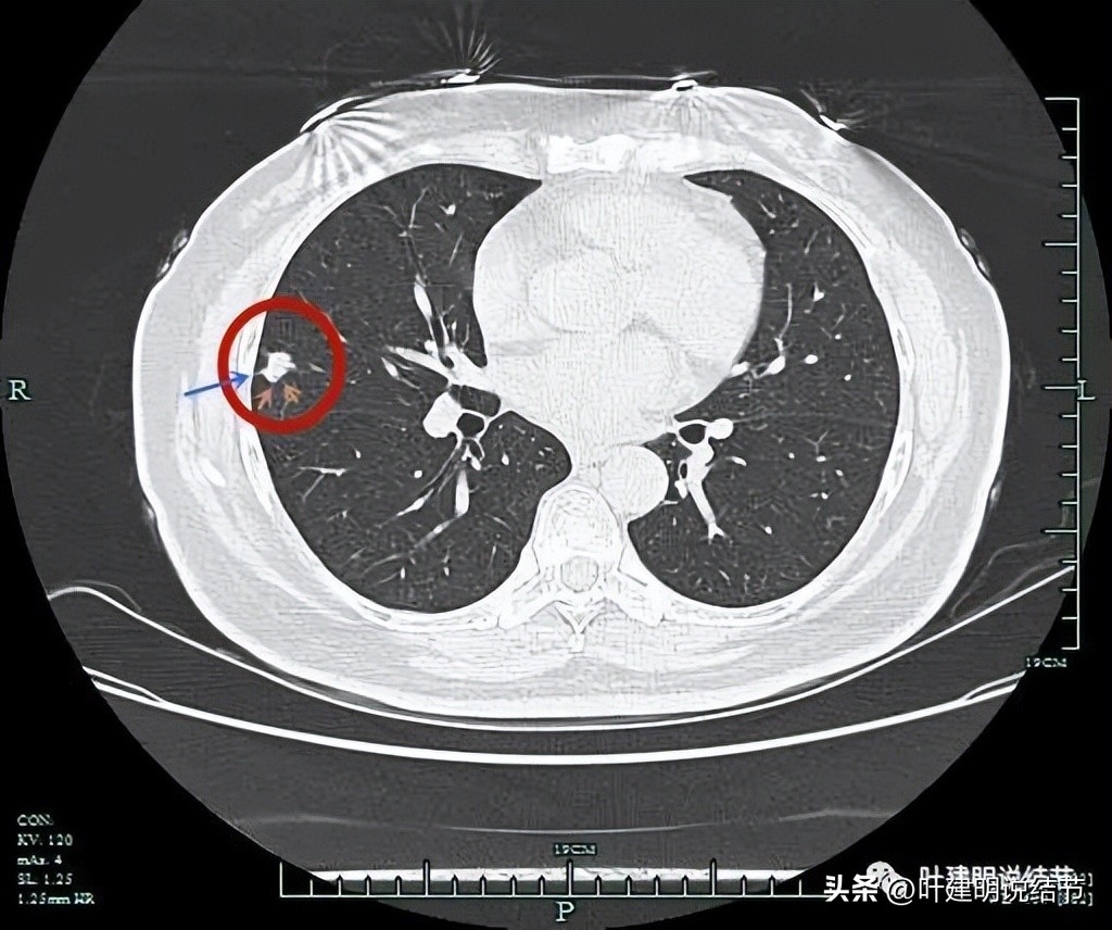 子宫内膜癌术后病灶大于二厘米,子宫内膜癌手术后一年又发现肺癌