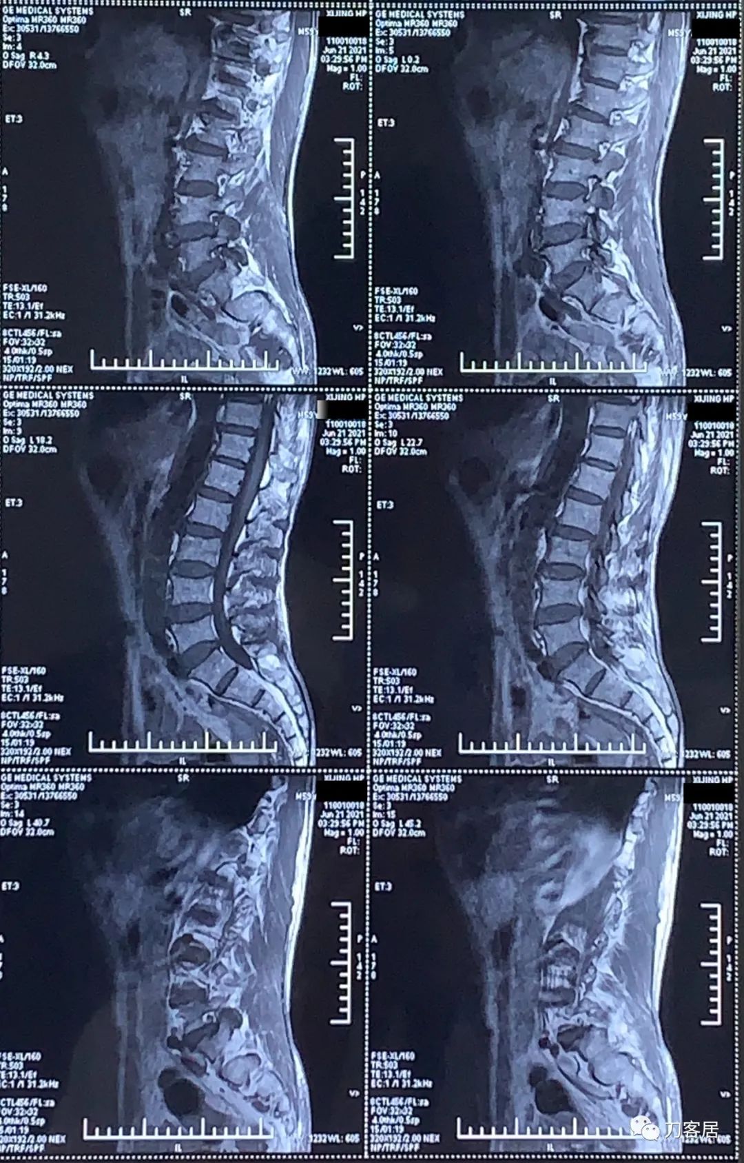髋部疼，小腿肚胀、抽筋，折腾了5年没效果，能用阿仑膦酸钠吗？