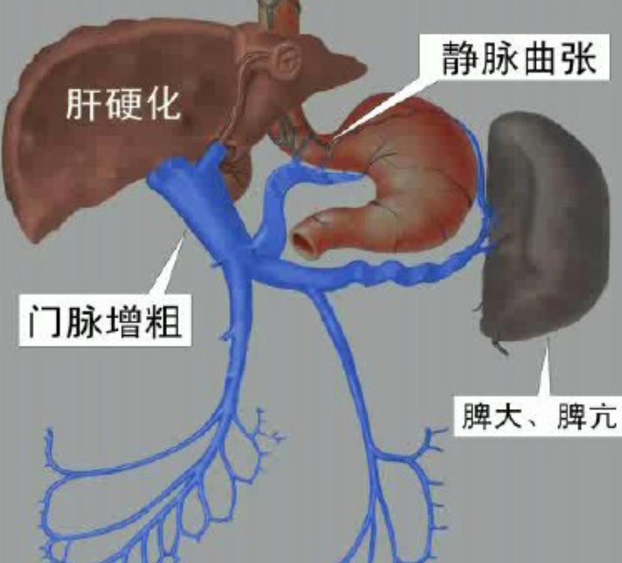 肝硬化门静脉高压吐血是什么阶段,肝硬化门静脉高压胃出血怎么治