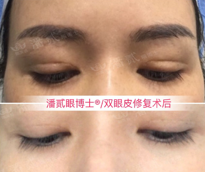 在整形医院割双眼皮多少钱,整形一般做双眼皮多少钱