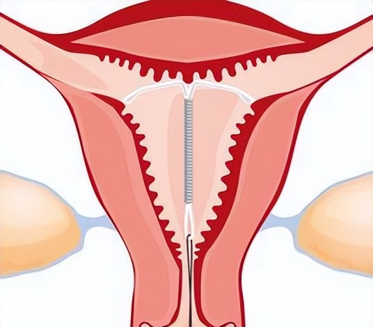 【科普】杭州一女士子宫里嵌进“钩子”，家有女性长辈注意！