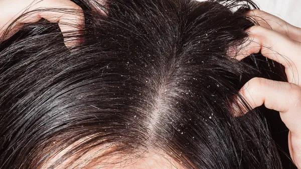 头部脂溢性皮炎原因,头部脂溢性皮炎是头皮癣吗