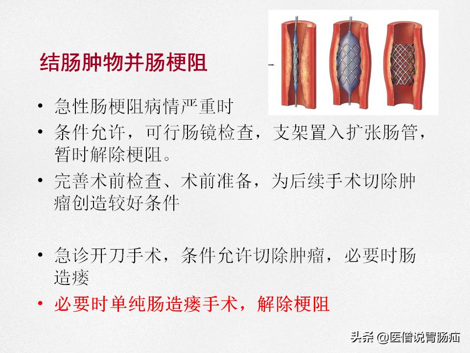 肠梗阻健康教育,肠梗阻患者的健康宣教