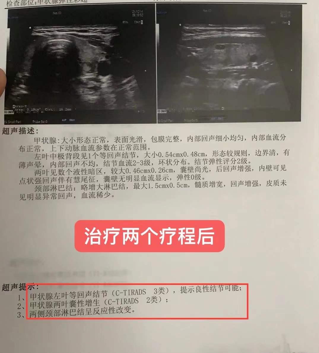 甲状腺结节4a类可以保守治疗么,王女士甲状腺结节