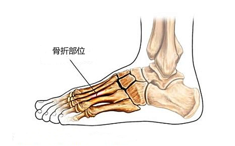 走路过多脚背肿胀冷敷还是热敷,脚背跖骨骨折最快恢复期时间多少