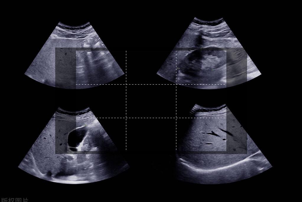 胆囊肿瘤的前兆,胆囊发生前期病变