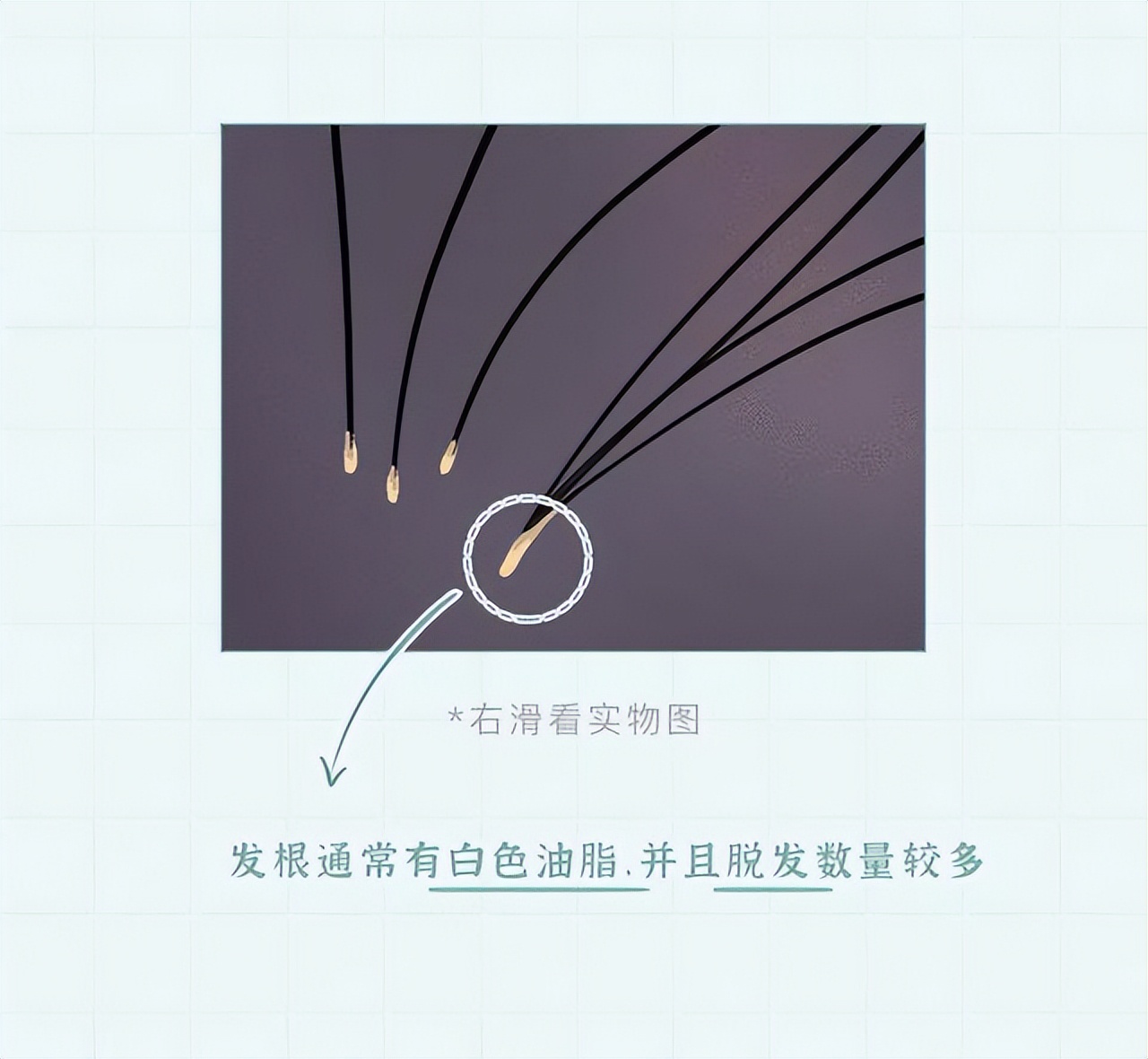 头皮内抠出白色颗粒状东西是什么,头皮上白色的小颗粒可以抠下来