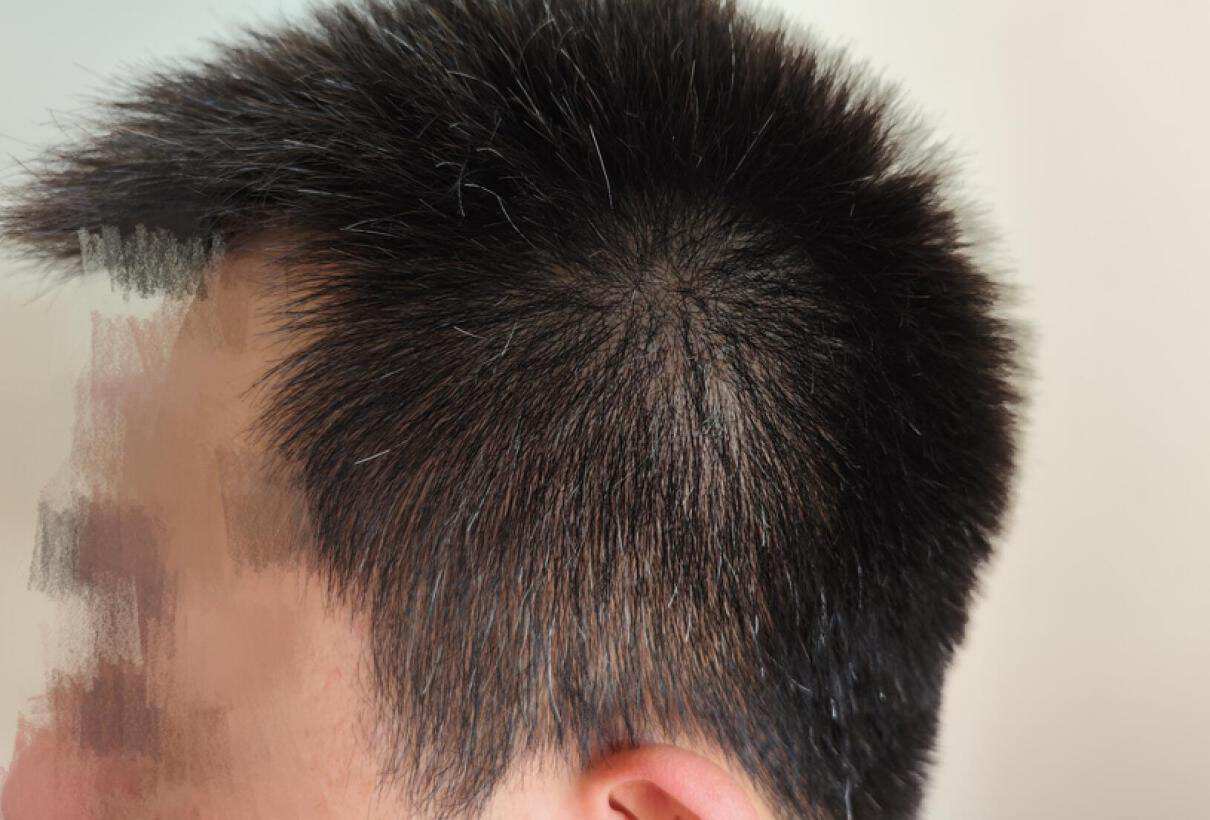 去头皮屑防掉发的洗发水推荐,脱发痒用哪一款洗发水比较好