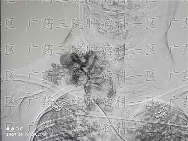 广州三甲医院宫颈癌筛查多少钱,广州哪家医院治疗宫颈癌最好的