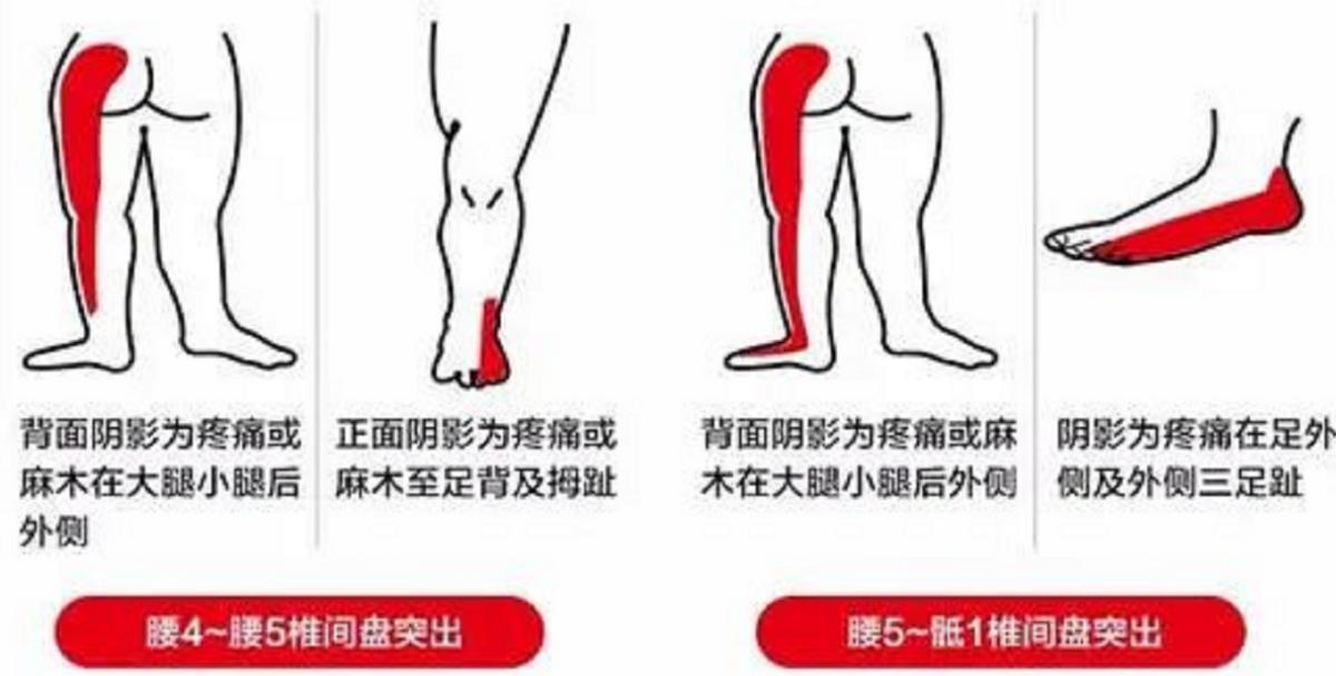 腰间盘突出腰痛脚麻怎么治疗好,腰椎间盘突出手术后腰痛脚麻